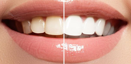 Teeth Whitening